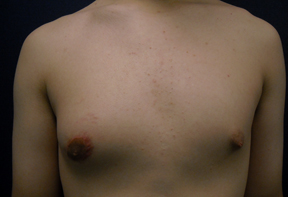 Chicago Gynecomastia chest lift